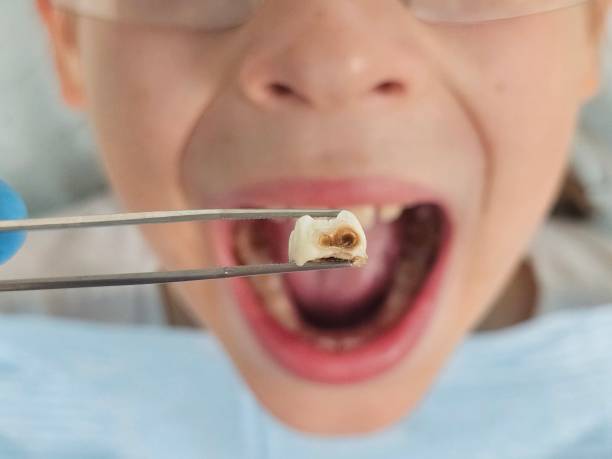 Best Root Canal Emergency Dentist  in Powder Springs, GA